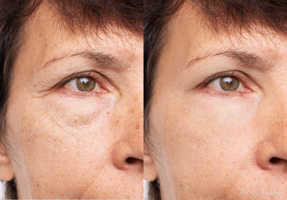 Before and after Laser Skin Resurfacing case 4774