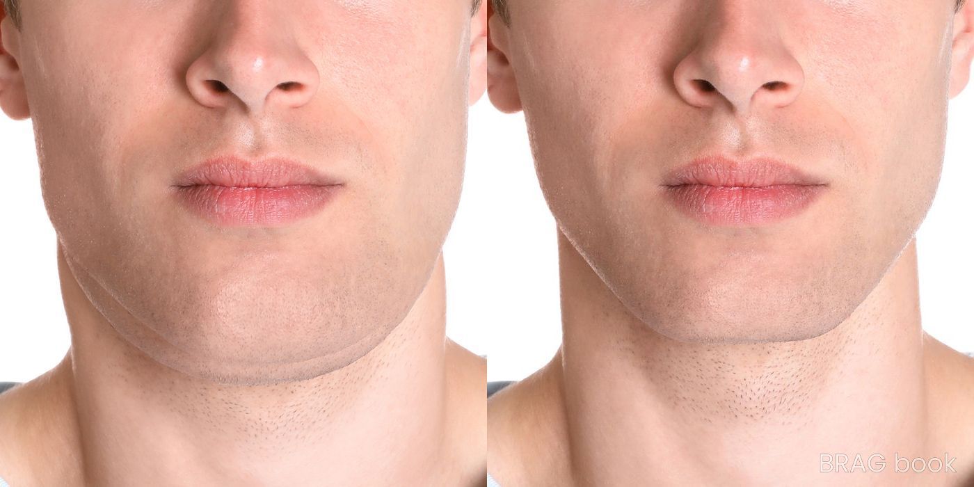 Before and after BOTOX Cosmetic case 10987