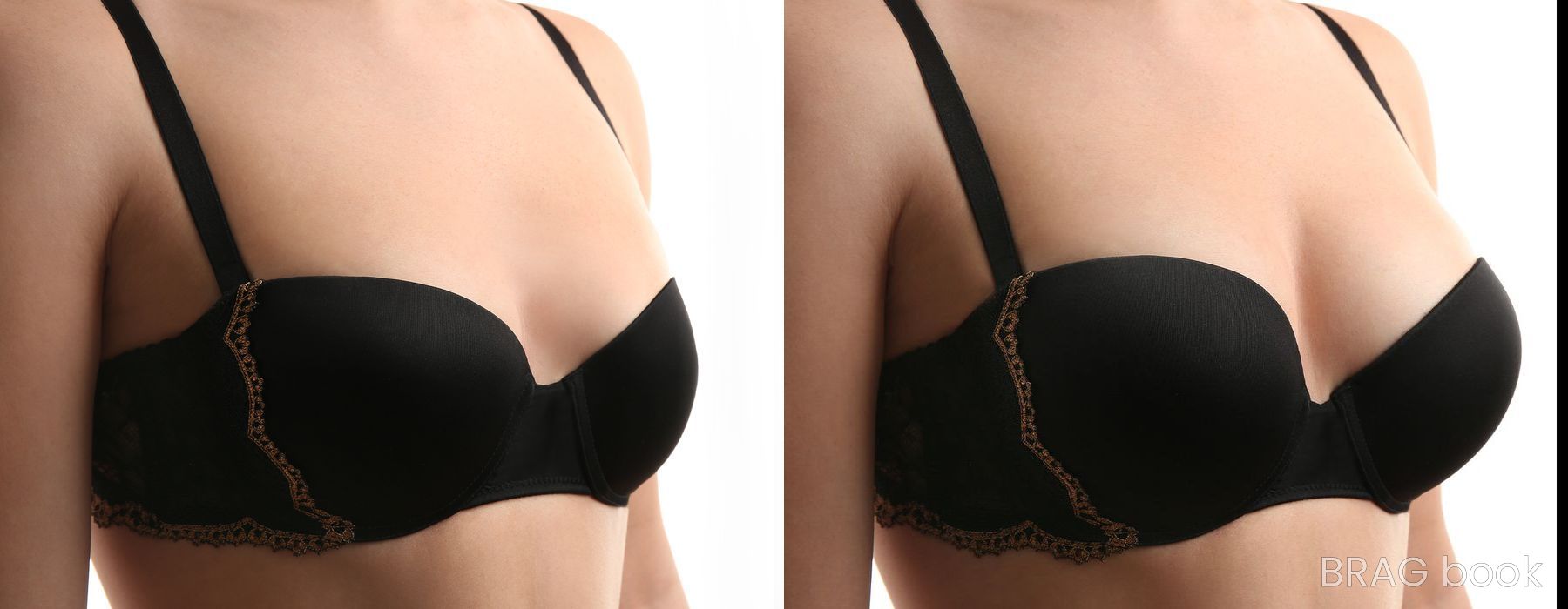 Before and after Breast Augmentation case 6491