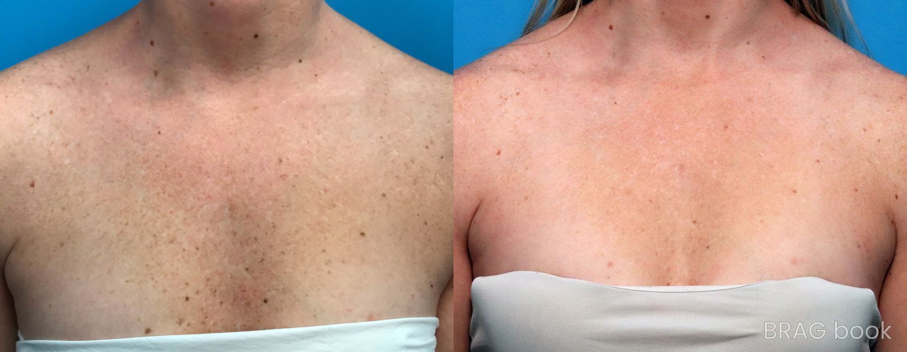 Before and after Photorejuvenation case 19717