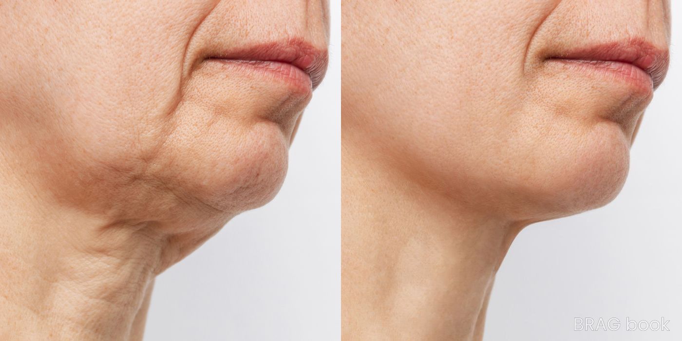 Before and after Morpheus 8 case 4757