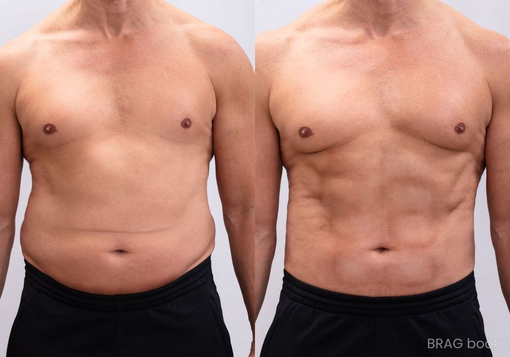 Before and after Liposuction case 4762