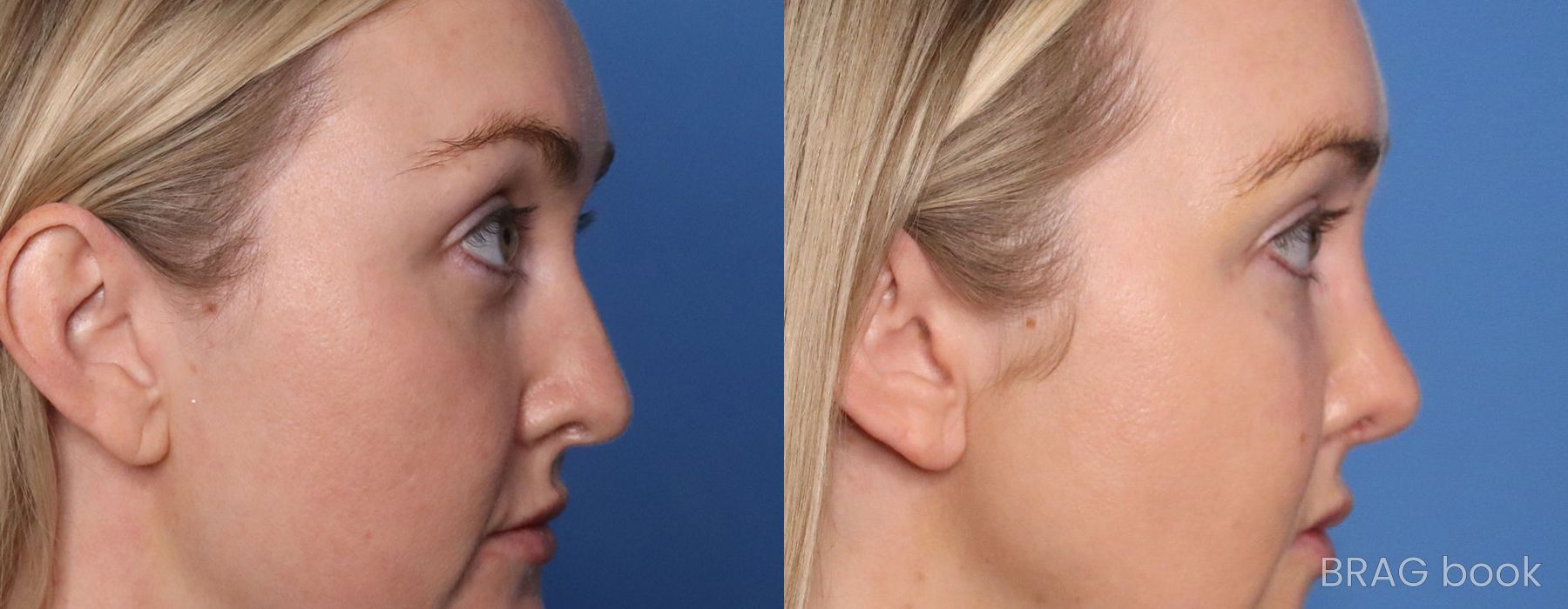 Before and after Brow Lift case 26219