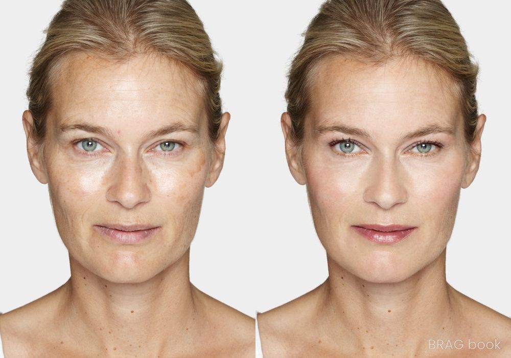 Before and after Laser Skin Resurfacing case 4749