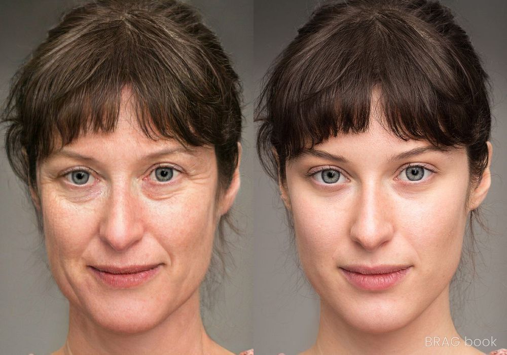 Before and after Laser Skin Resurfacing case 4754