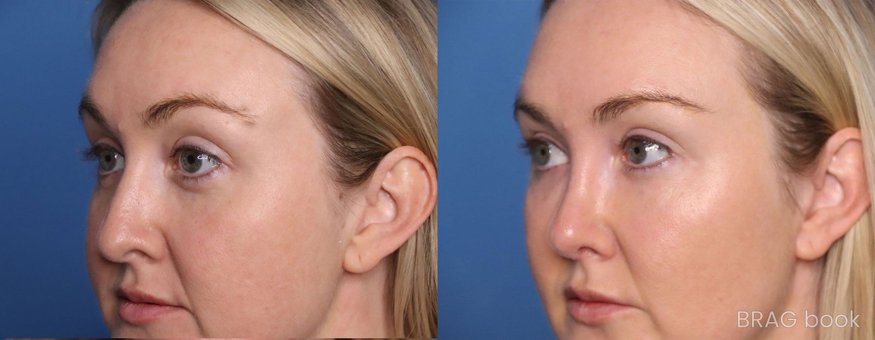 Before and after Facelift case 19715 - Angle 3