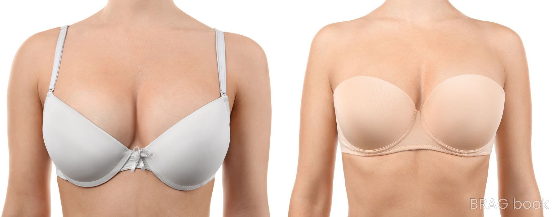 Before and after Tummy Tuck case 23912 - Angle 2