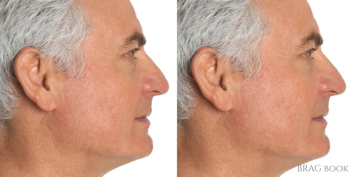 Cheek Augmentation - Case 2002