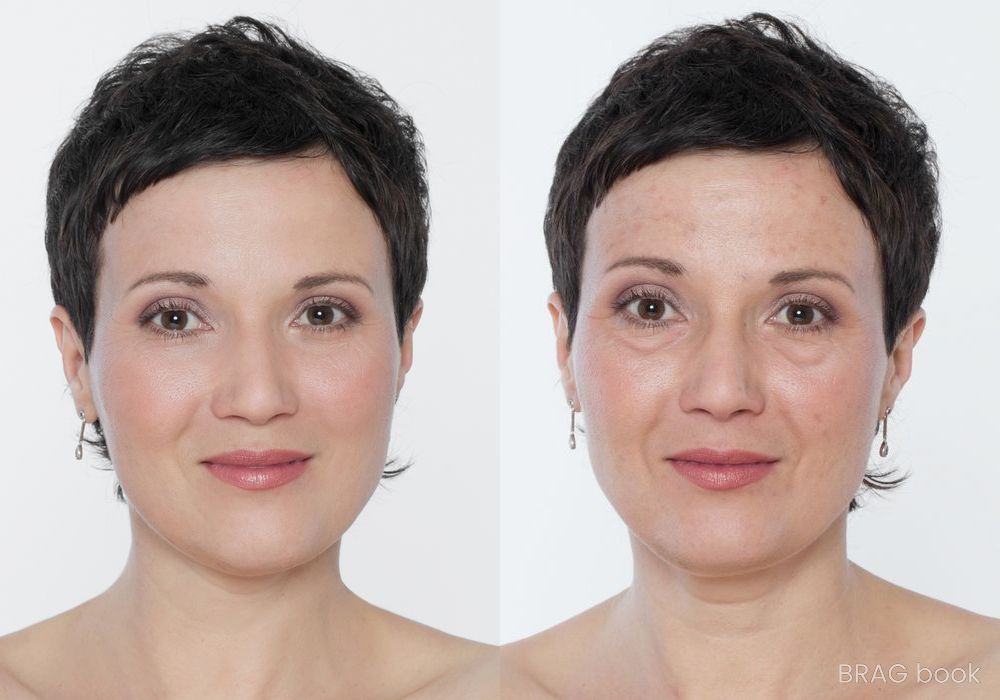 Before and after BOTOX Cosmetic case 12305