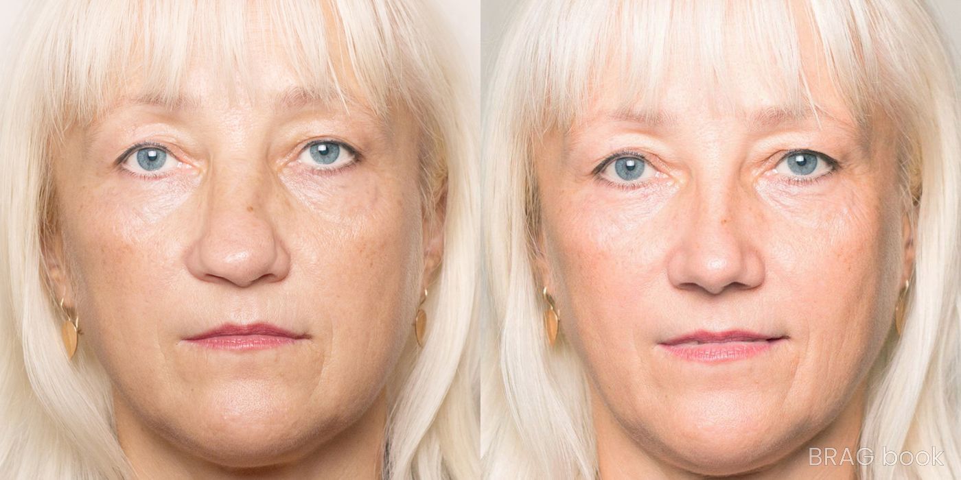 Before and after Rhinoplasty case 4748