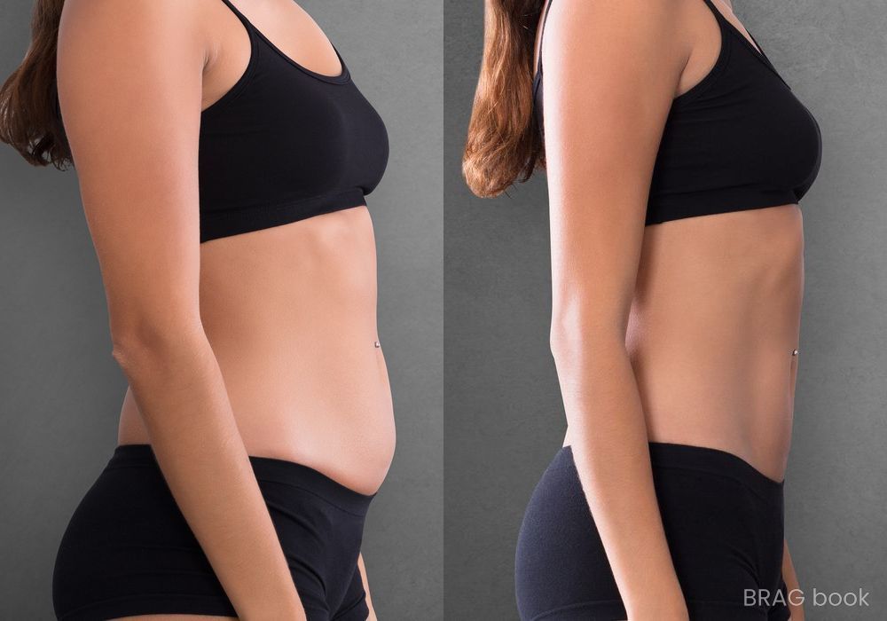 Before and after Emsculpt Neo case 4761 - Angle 2