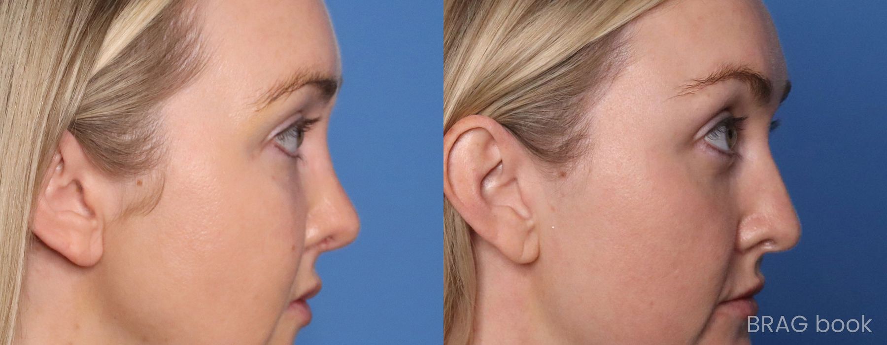 Before and after Brow Lift case 26219 - Angle 3