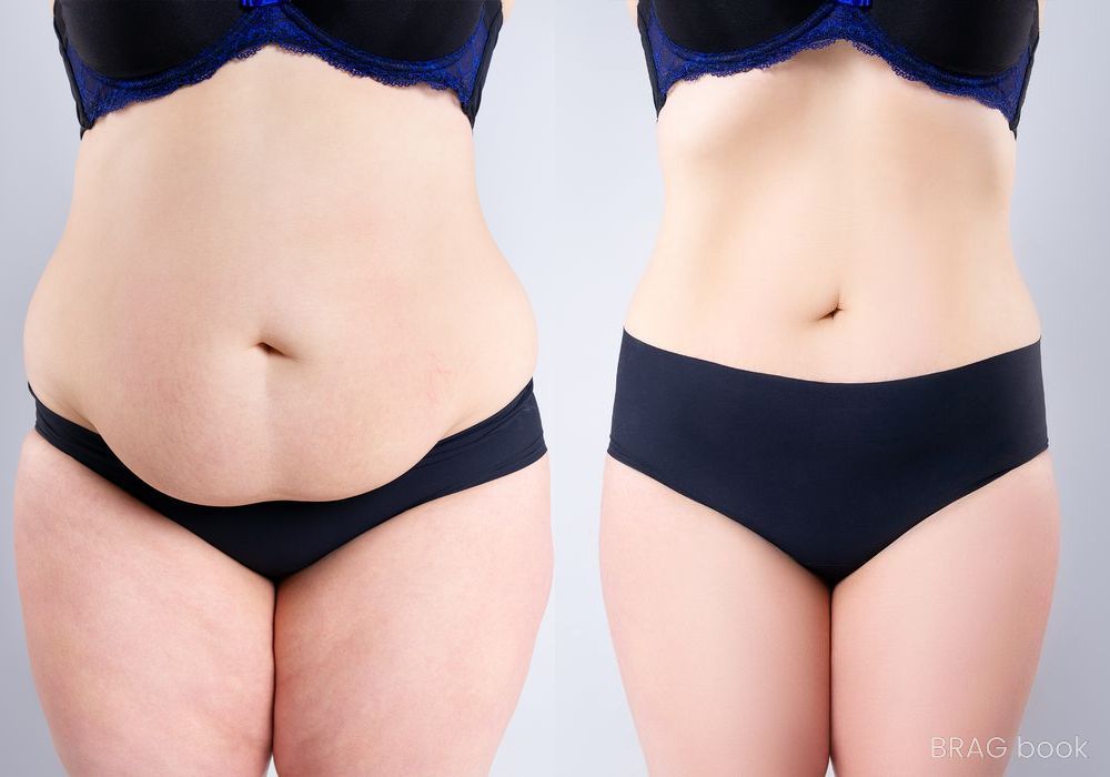 Before and after Liposuction case 4788