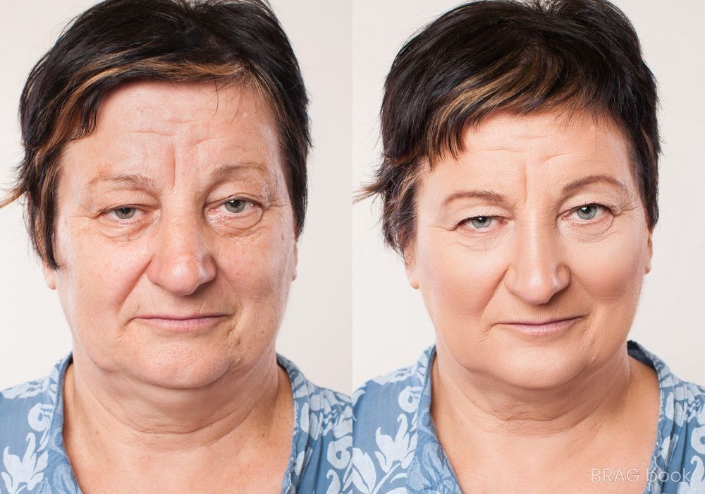 Before and after Laser Skin Resurfacing case 4752