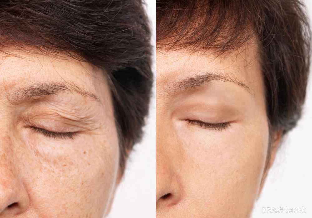 Before and after Brow Lift case 4770
