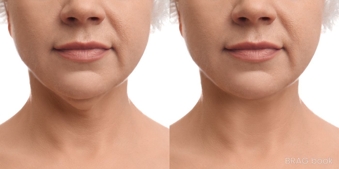 Before and after Chin Augmentation case 13459 - Angle 2