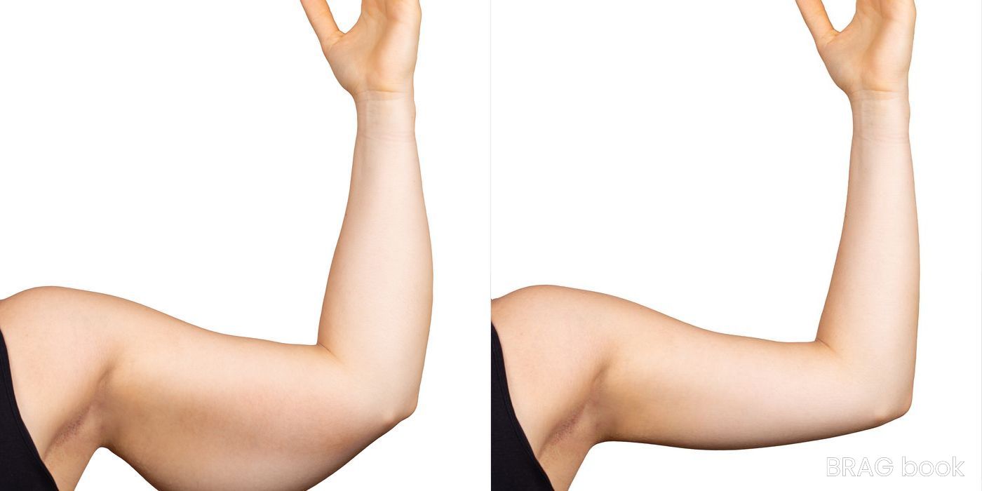 Before and after Arm Lift case 4743