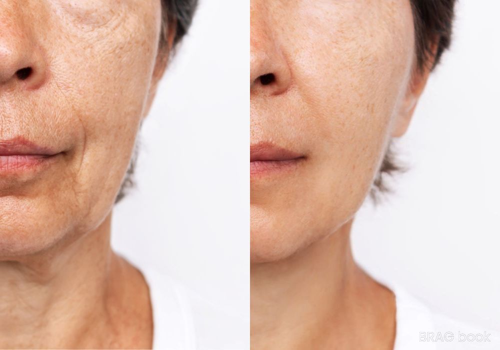 Before and after Laser Skin Resurfacing case 4773