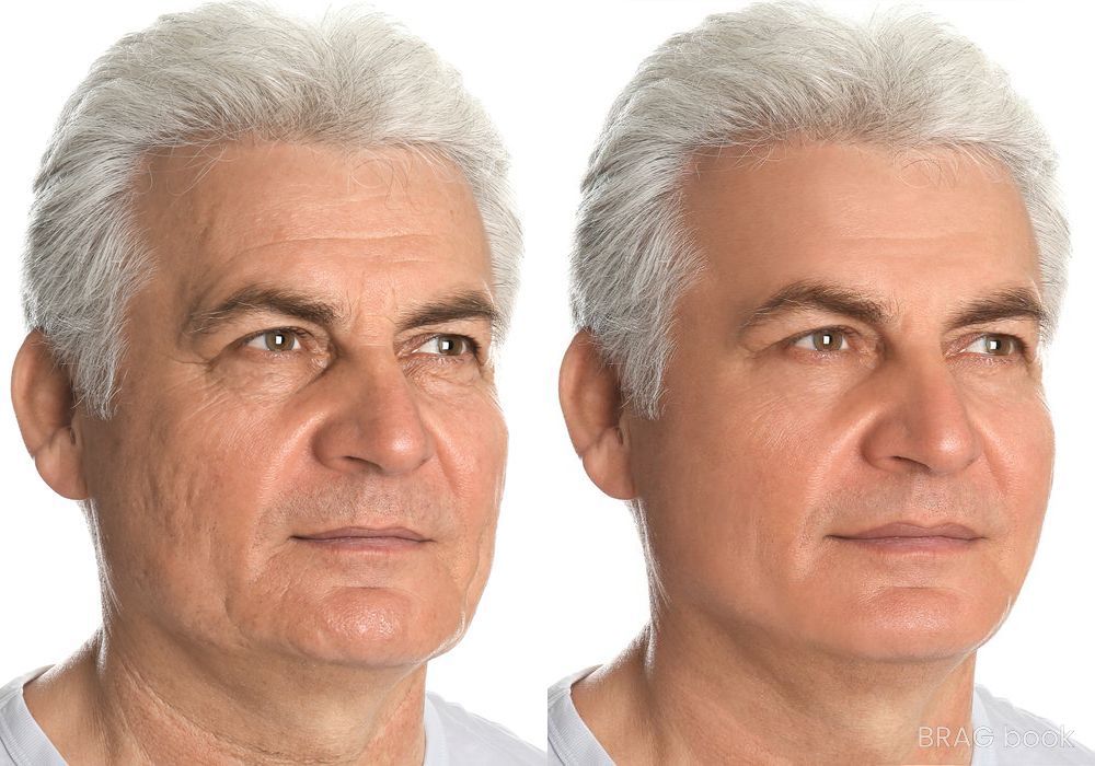 Before and after Laser Skin Resurfacing case 4766 - Angle 2