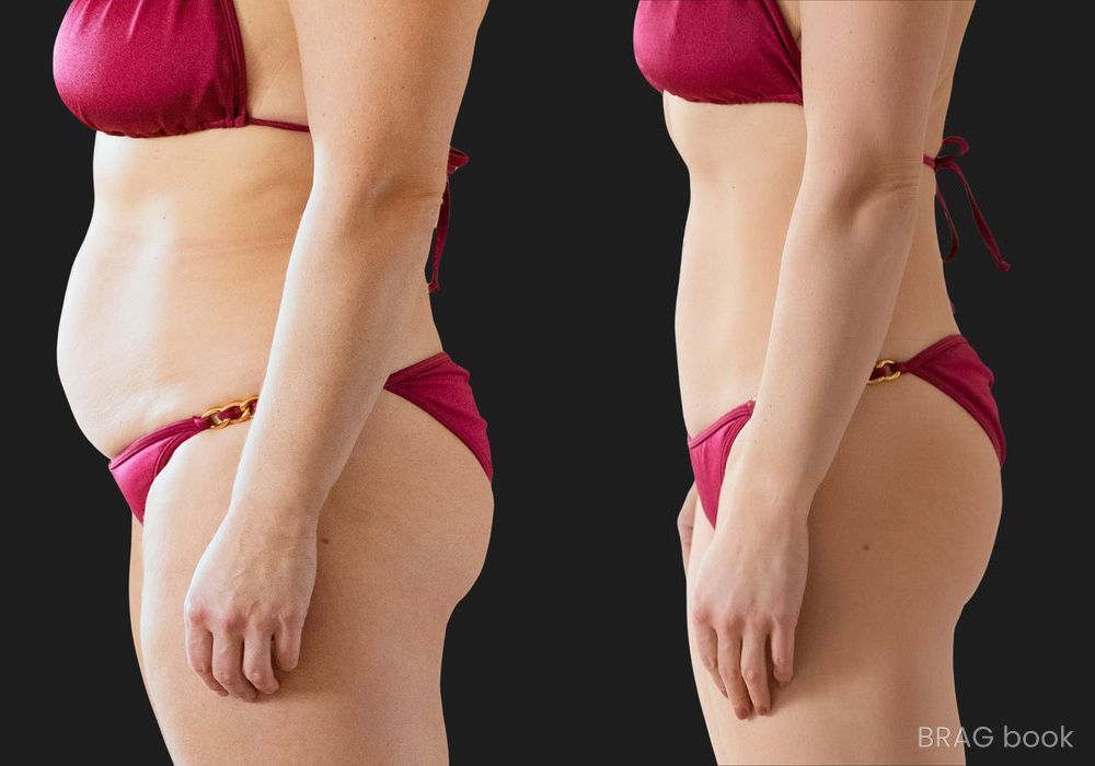 Before and after Liposuction case 23890 - Angle 2