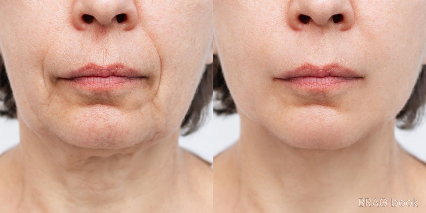 Before and after Morpheus 8 case 4758