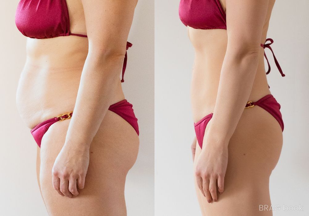 Before and after Liposuction case 23819 - Angle 2