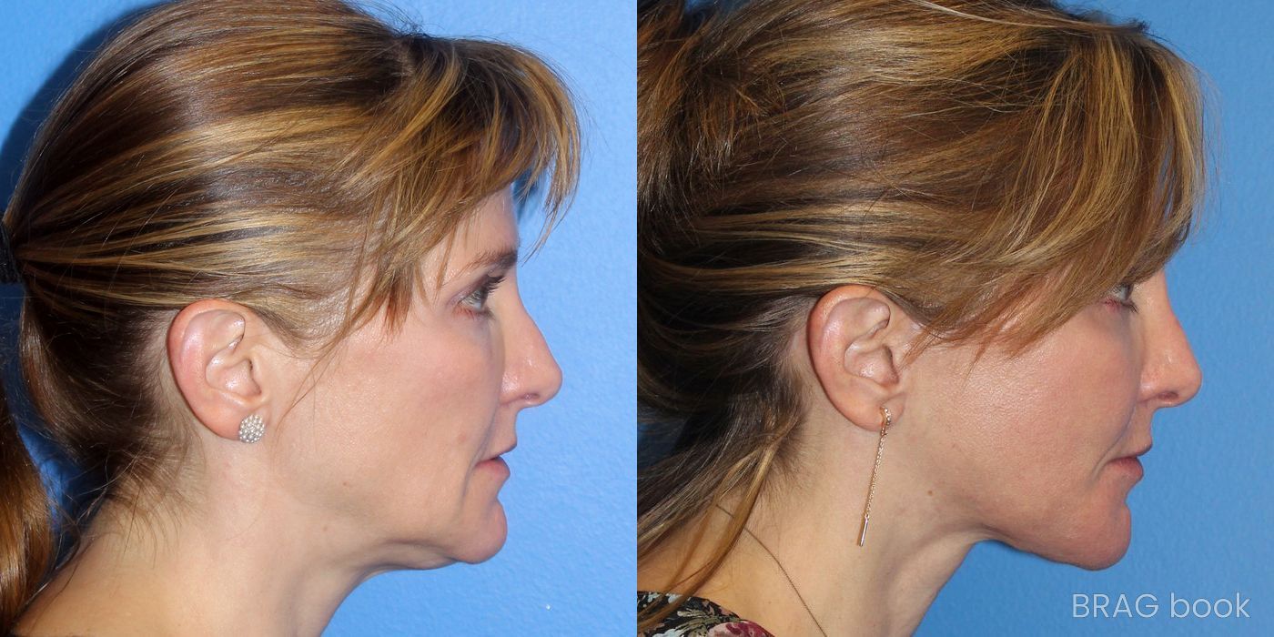 Before and after Facelift case 21711 - Angle 2