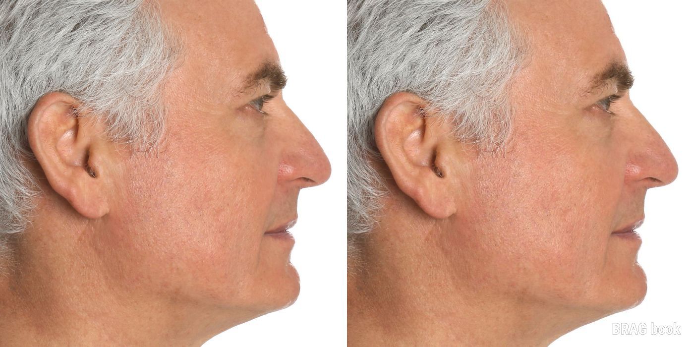 Blepharoplasty - Thumbnail 2