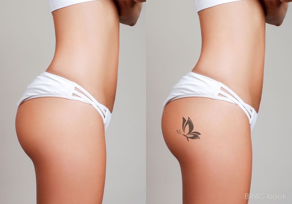 Before and after Breast Augmentation case 17180 - Angle 2