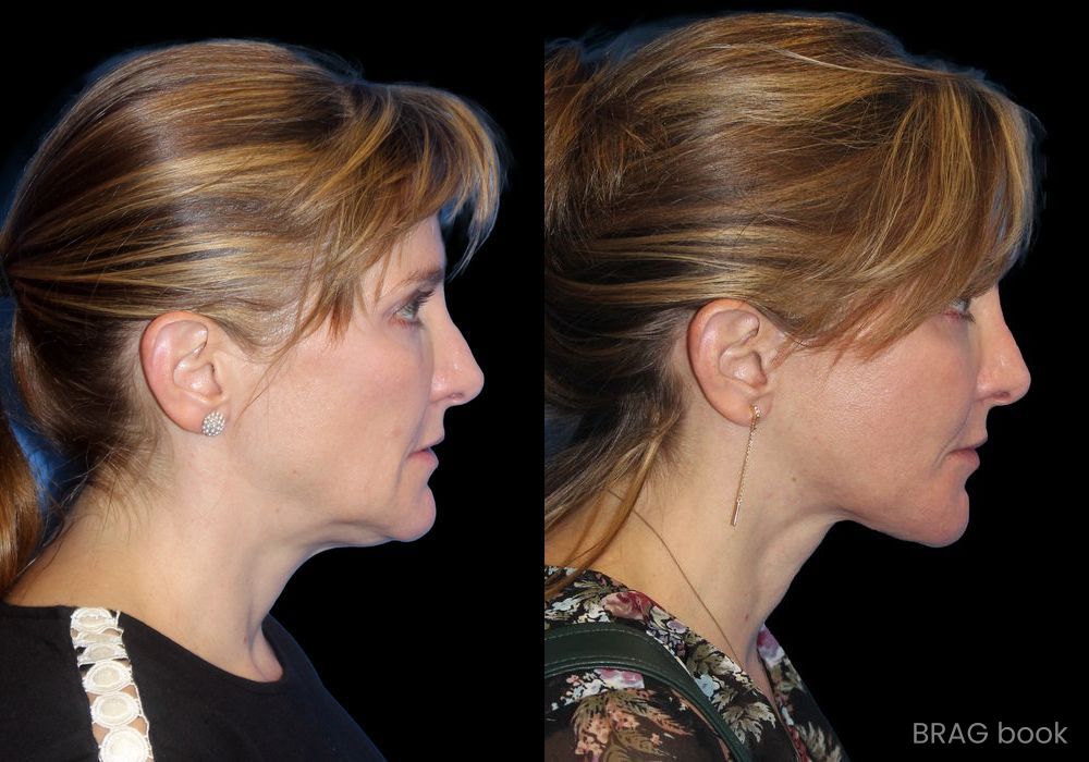 Before and after Neck Lift case 19719
