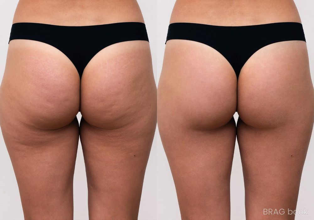 Before and after Cellulite Reduction case 4760