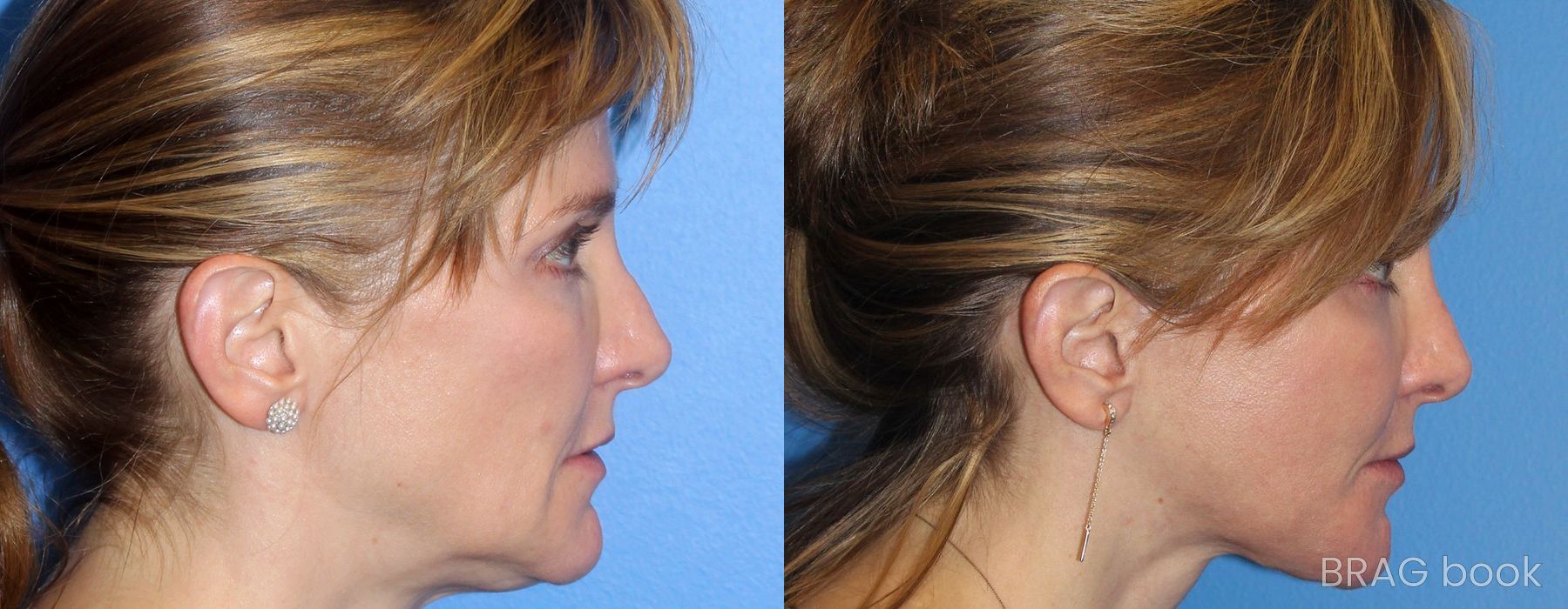 Before and after Brow Lift case 26219 - Angle 2