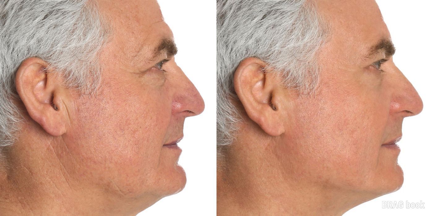 Blepharoplasty - Case 1994