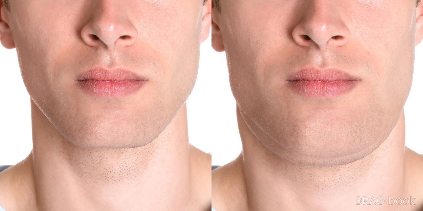Before and after Chin Augmentation case 6278