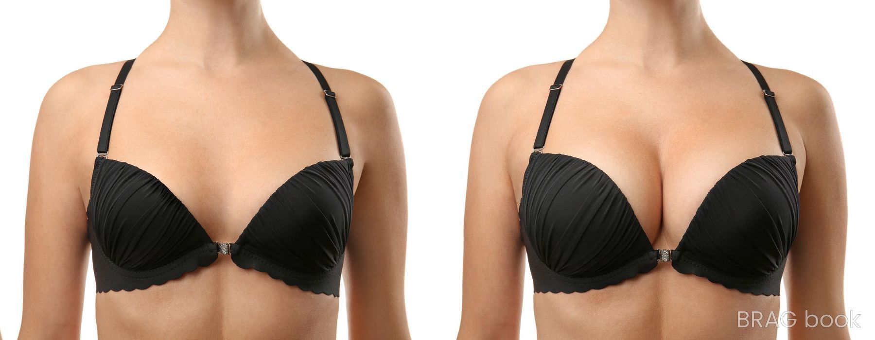 Before and after Breast Augmentation case 6982 - Angle 3