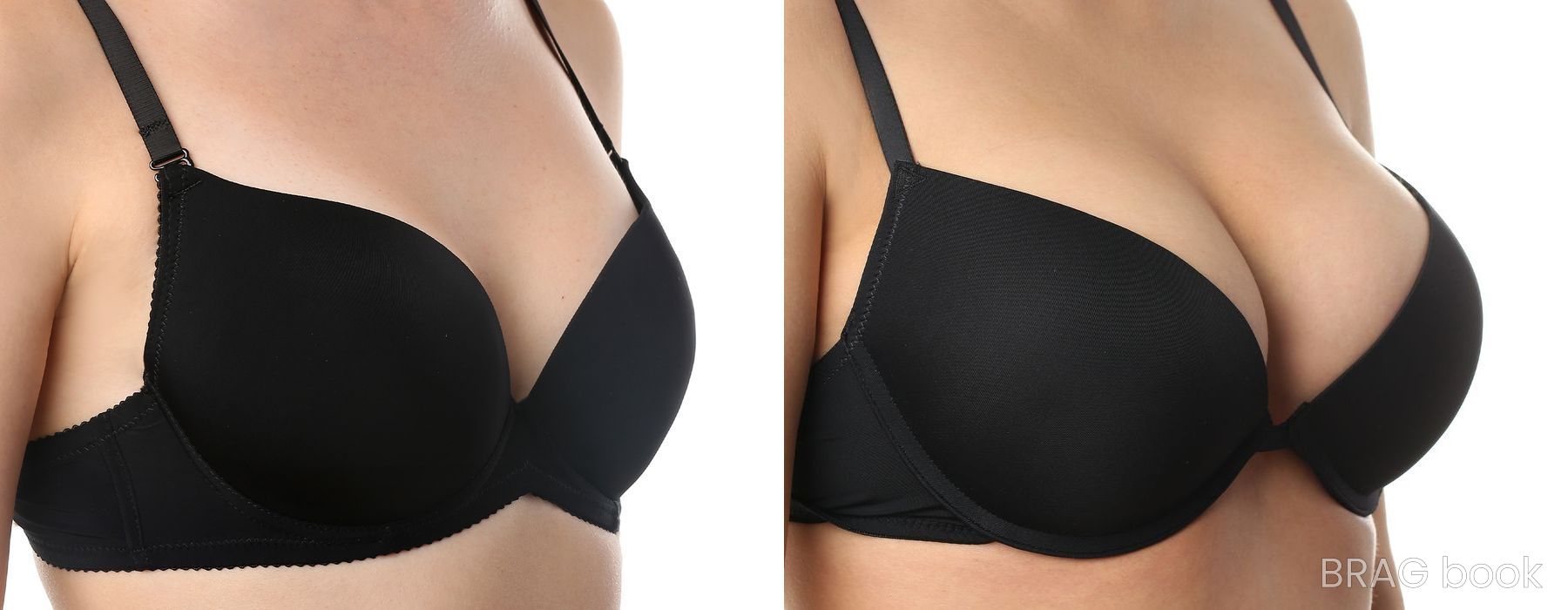 Before and after Breast Augmentation case 6491 - Angle 2