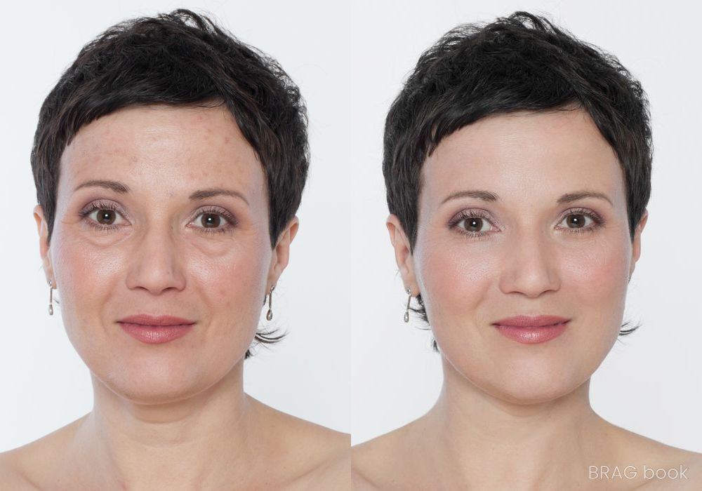 Before and after BOTOX Cosmetic case 12356