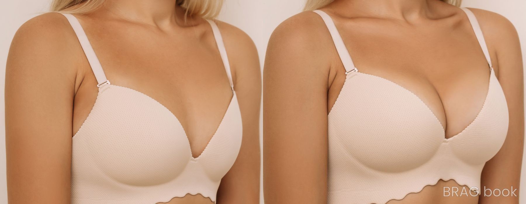 Before and after Breast Augmentation case 4787 - Angle 2