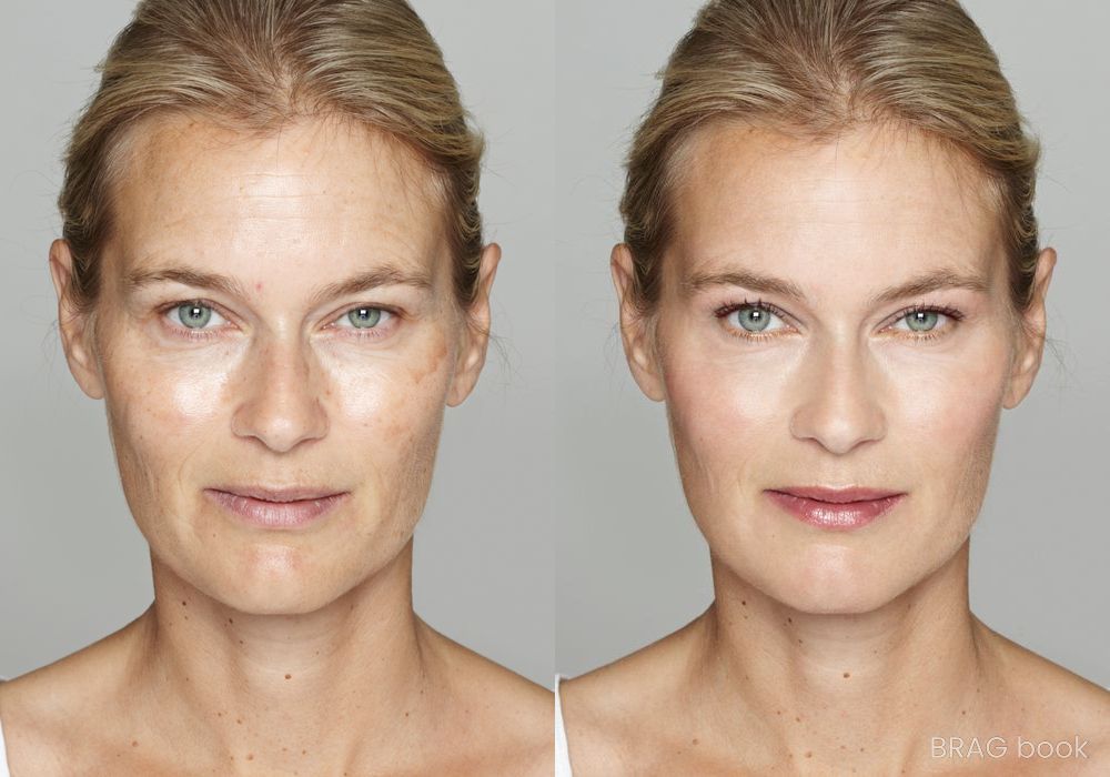 Before and after Peels & Facials case 4779