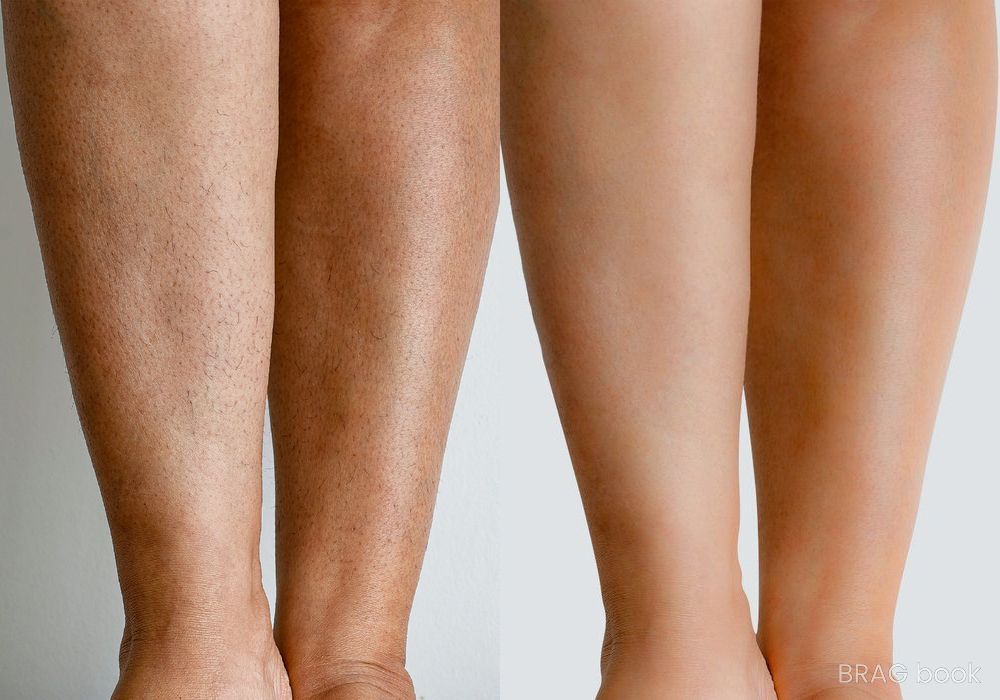 Before and after Laser Hair Reduction case 4756