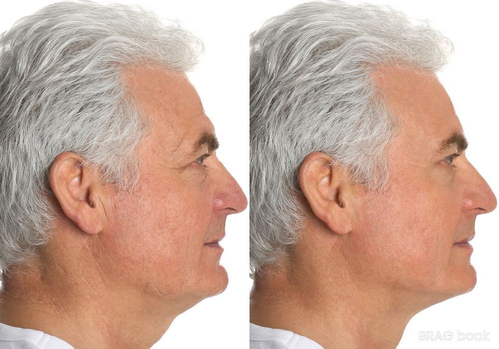 Before and after Laser Skin Resurfacing case 4766 - Angle 3