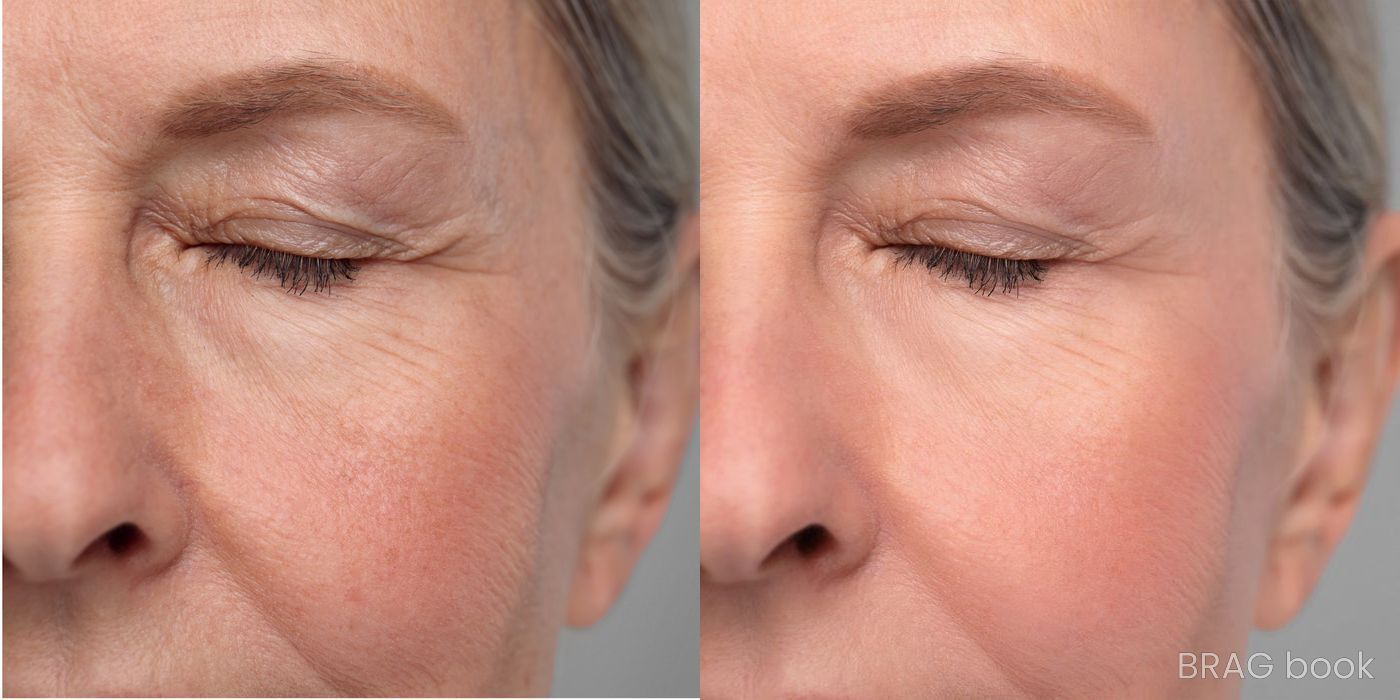 Before and after Photorejuvenation case 4769 - Angle 2