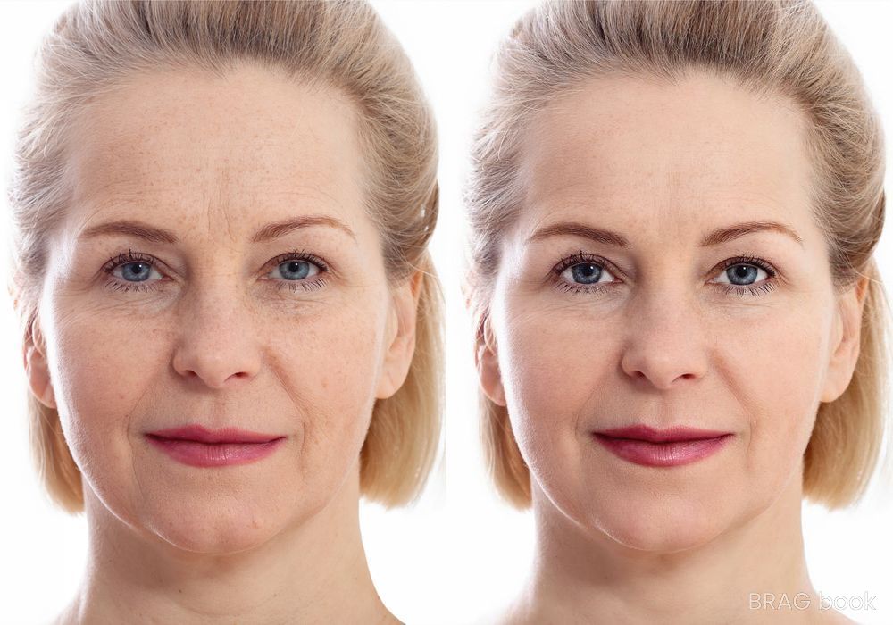 Before and after Laser Skin Resurfacing case 4753