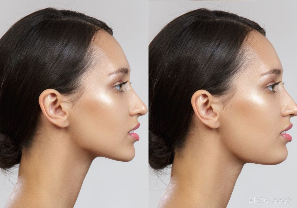 Before and after Blepharoplasty case 18547