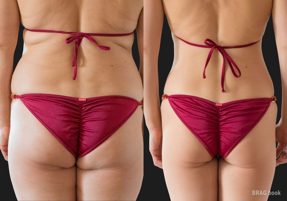 Liposuction - Thumbnail 3