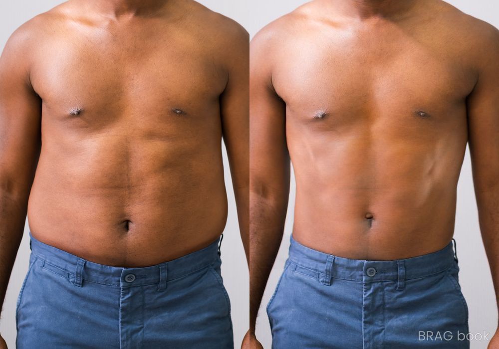 Before and after Liposuction case 4764