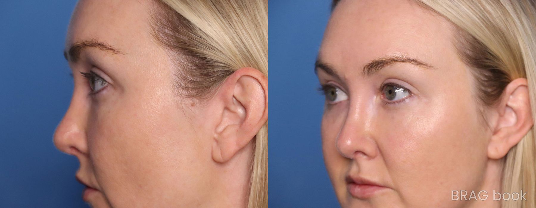 Before and after BOTOX Cosmetic case 21487 - Angle 2