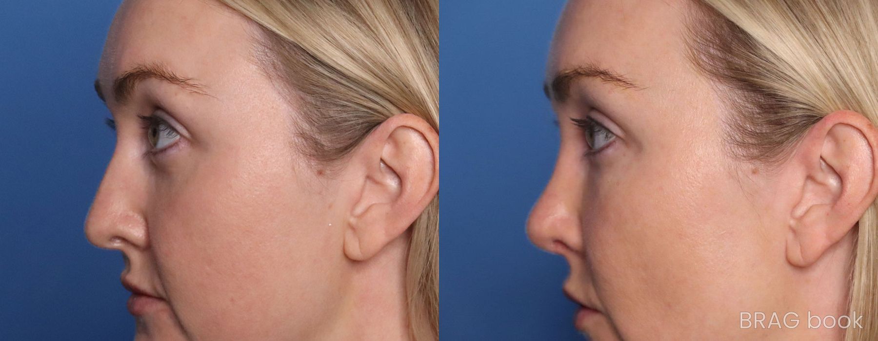 Before and after Facelift case 19715 - Angle 5