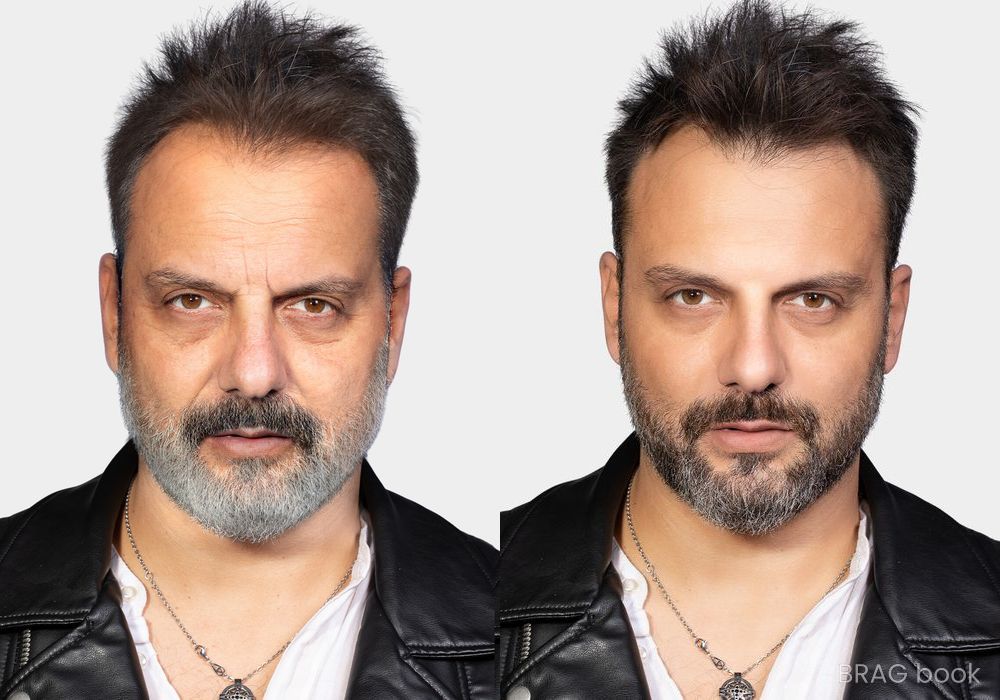 Before and after Laser Skin Resurfacing case 4751