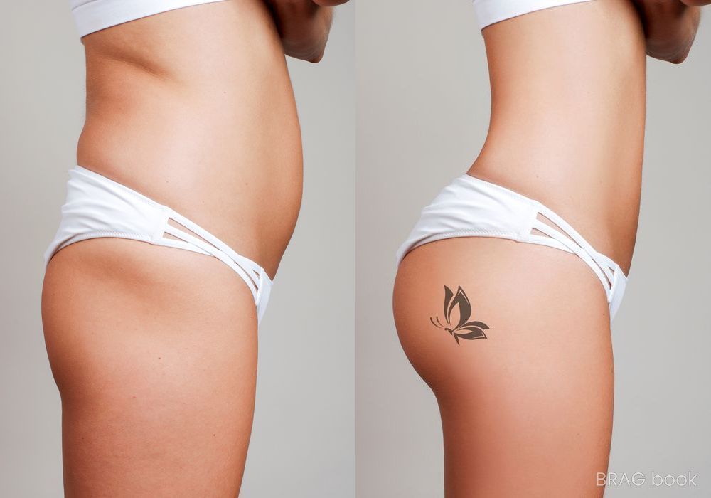 Before and after Brazilian Butt Lift case 16840